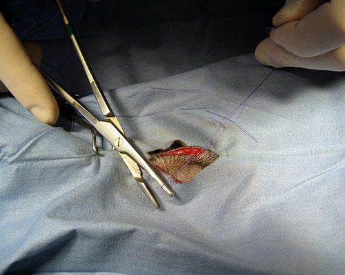 Closing the incision