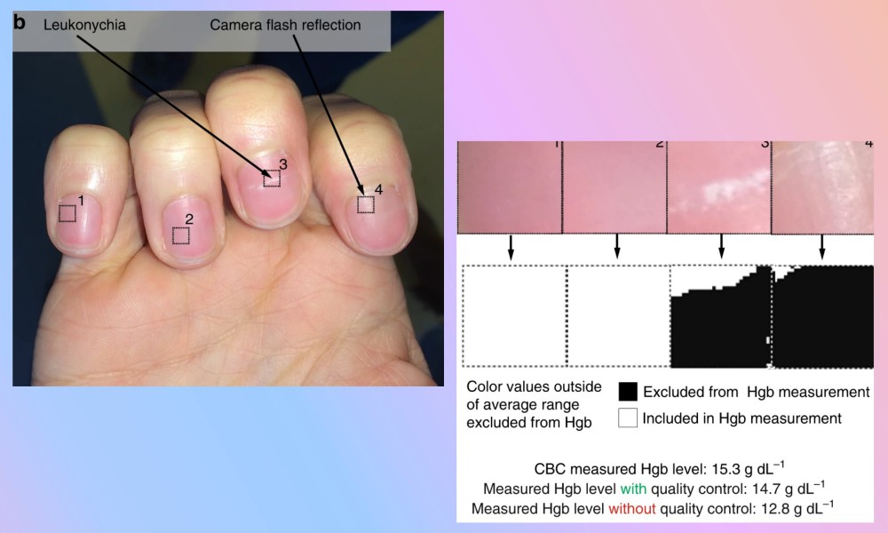 Analysis of nail color by a mobile app.